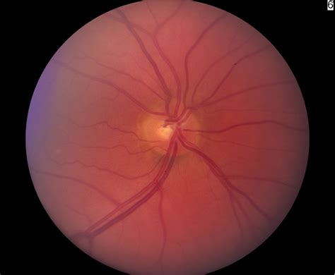 normal size of optic nerve